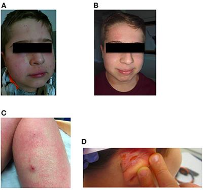 Case Report: Dupilumab Successfully Controls Severe Eczema in a Child With Elevated IgE Levels and Recurrent Skin Infections